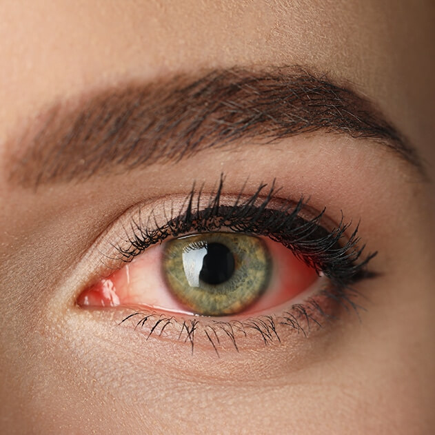 Closeup of a Red Eye