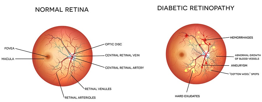 Chart Illustrating a Normal Retina Compared to One Going Through Diabetic Retinopathy